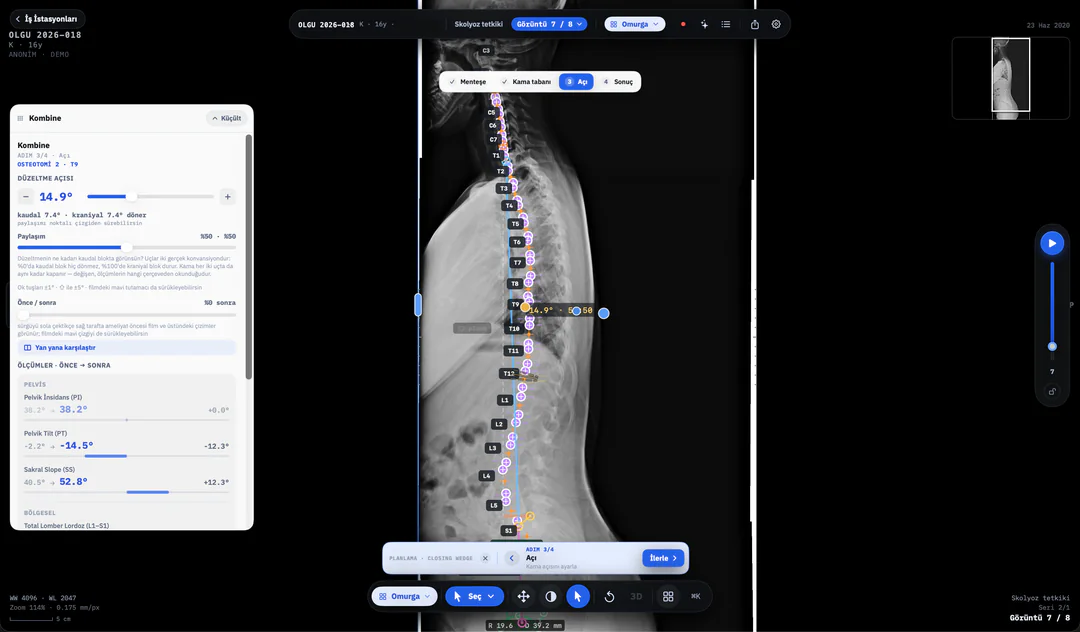 dicom-axle planlama — kapalı kama, önce