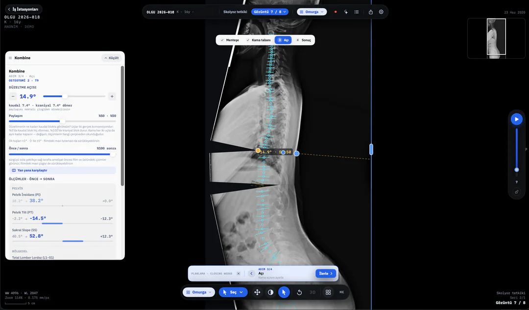 dicom-axle planlama — kapalı kama